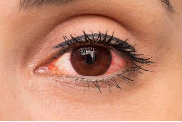 Красные глаза: причины, лечение